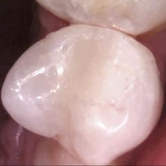 Decayed 2nd premolar After