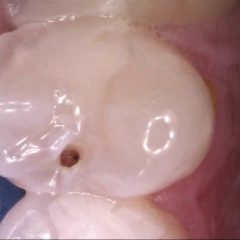 Decayed 2nd premolar before