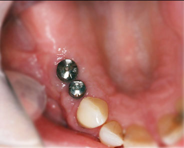 dental implant healing