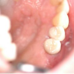 dental implant with crown