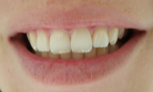 bleached teeth before treatment